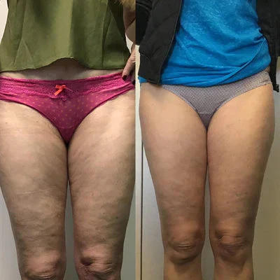 Appareil Anti-Cellulite Chauffant - Image 6