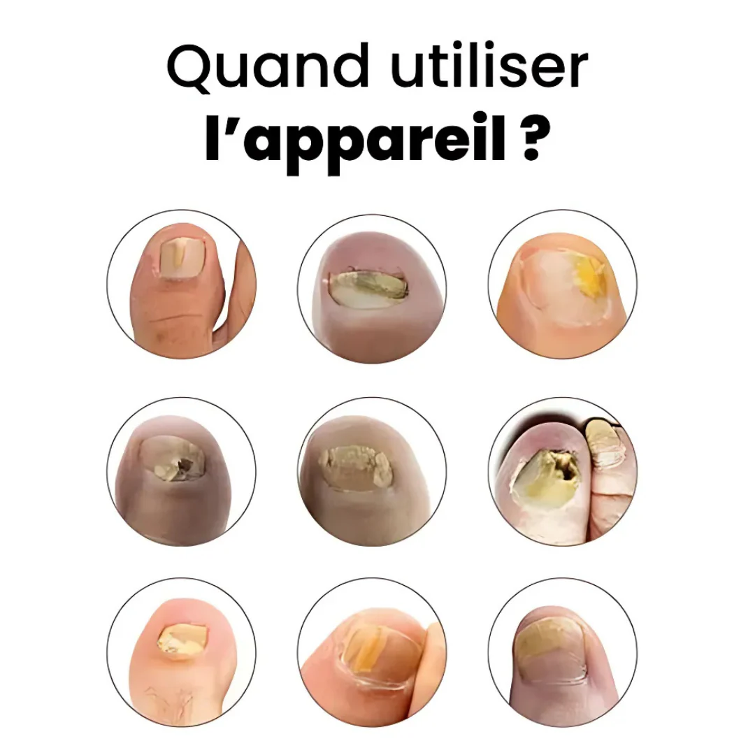 Appareil contre les mycoses des ongles - Image 7