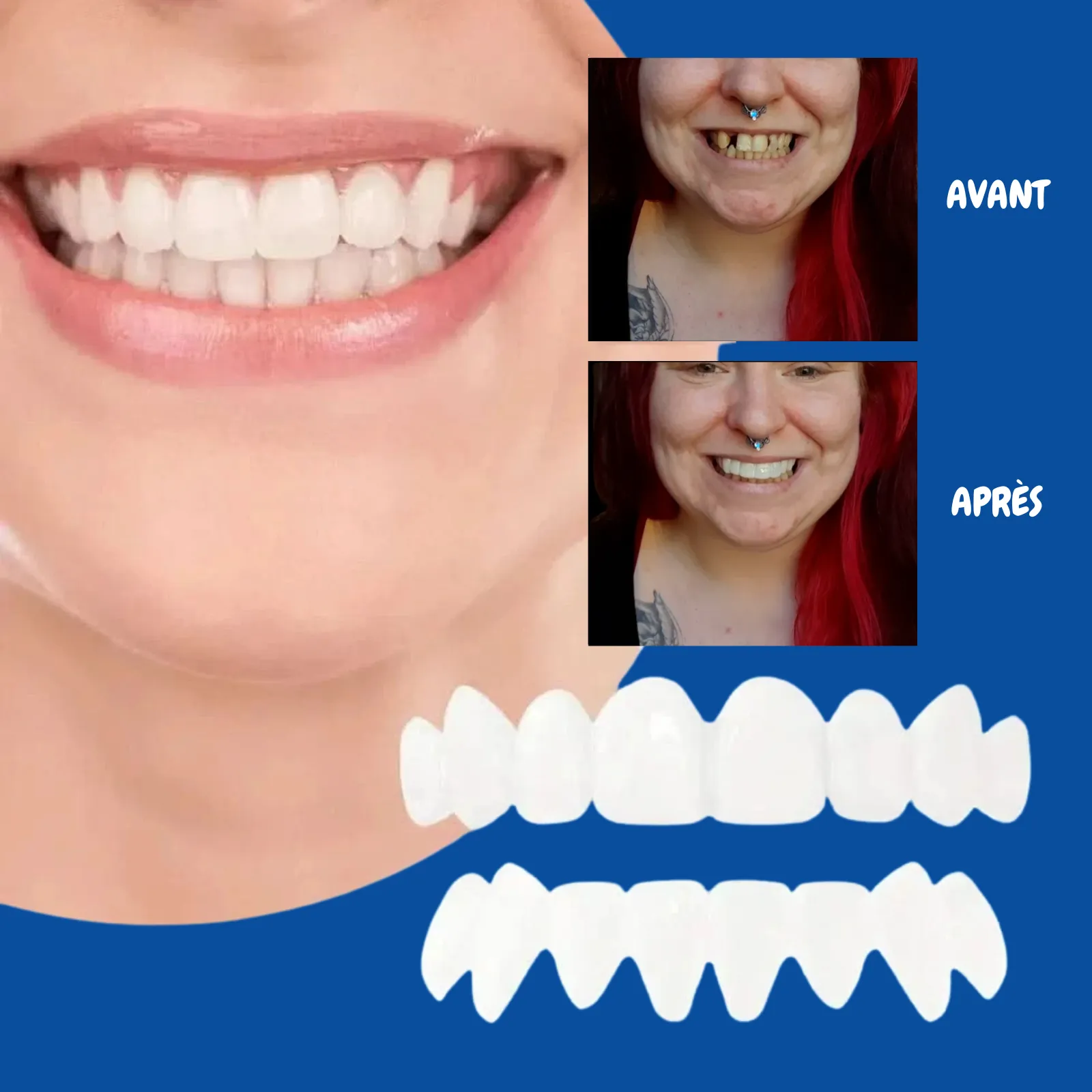 Facettes dentaires souples à clipser – Sourire immédiat sans douleur - Image 4