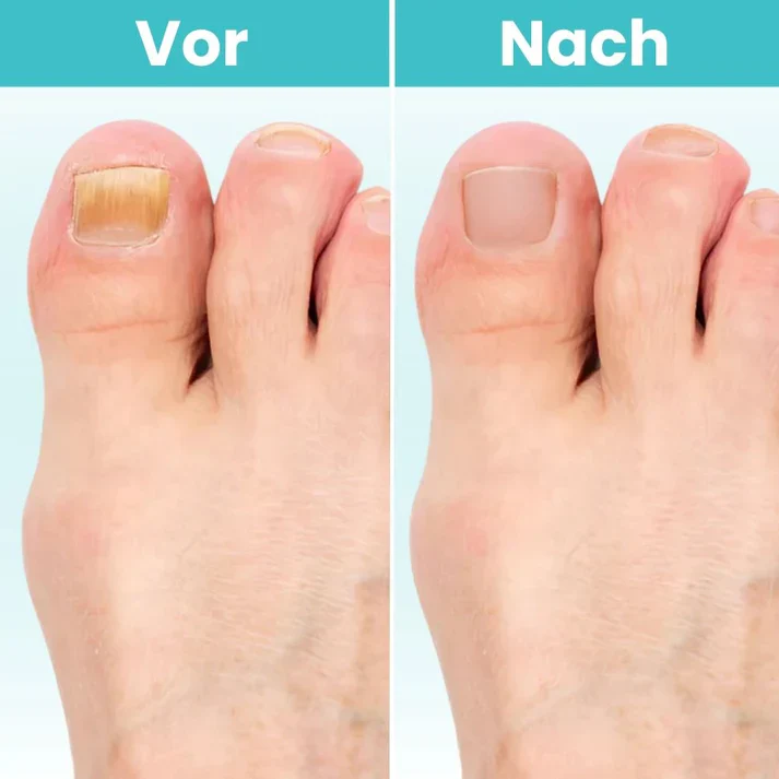 FungiClear Pro – Appareil laser contre la mycose des ongles - Image 5