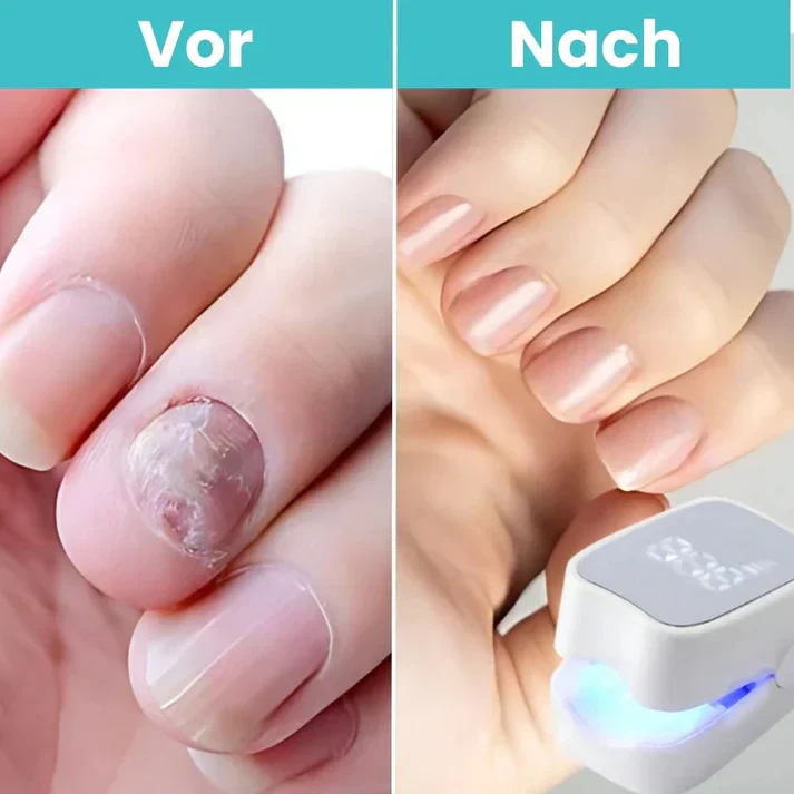 FungiClear Pro – Appareil laser contre la mycose des ongles - Image 6
