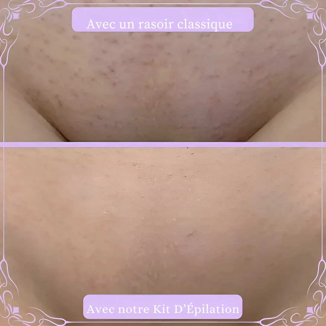 Kit d'épilation efficace et en douceur à domicile - Image 3