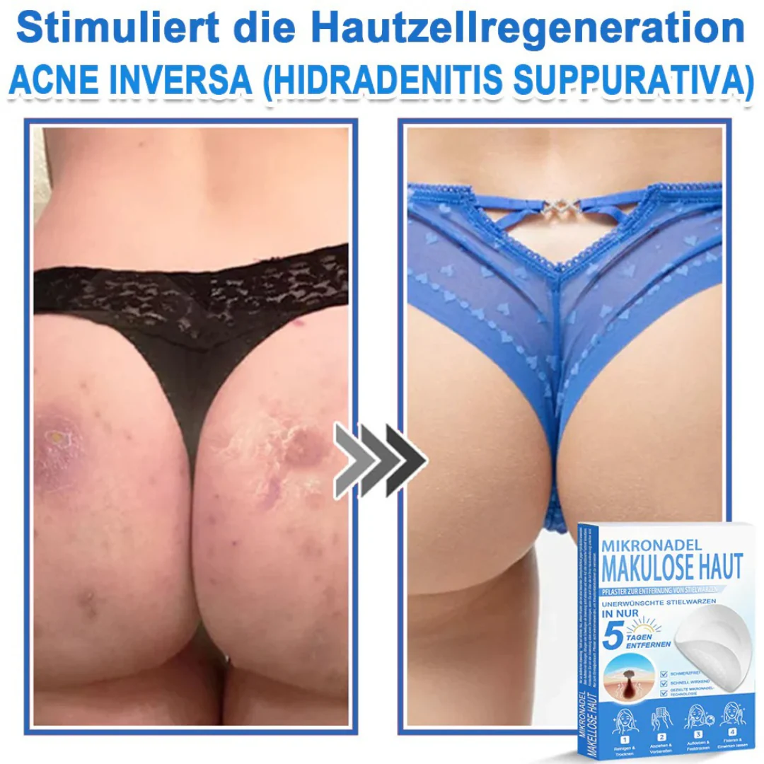 Patchs micro-aiguilles anti-boutons et imperfections visage - Image 10
