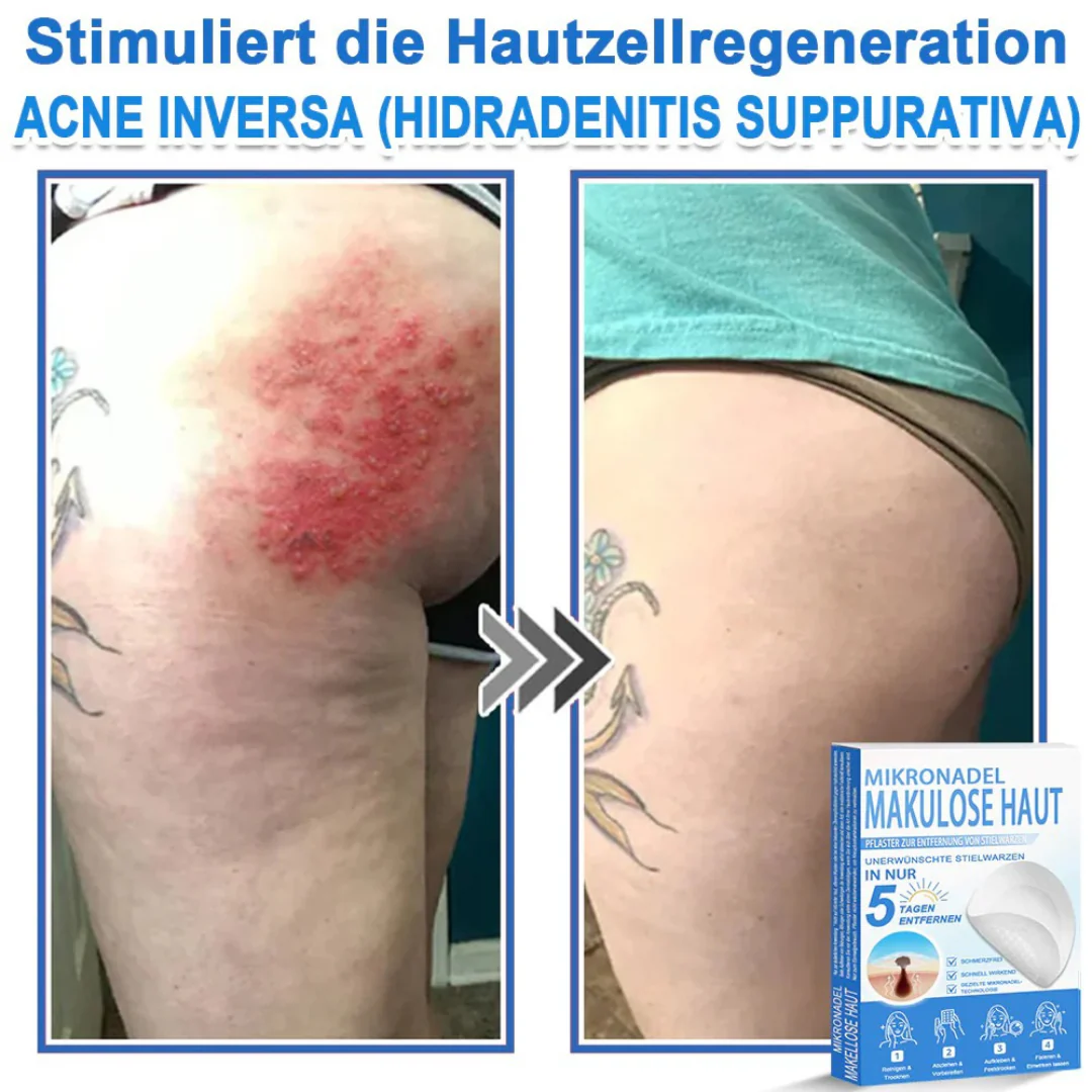 Patchs micro-aiguilles anti-boutons et imperfections visage - Image 11